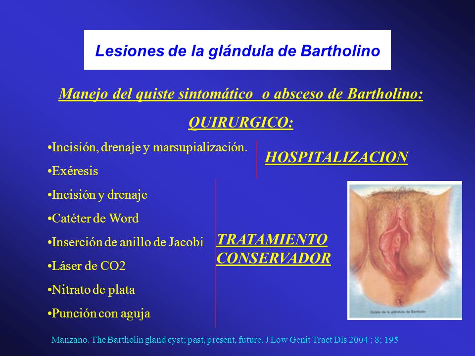 Quiste de bartolino tratamiento quirurgico Quiste de bartolino tratamiento quirurgico